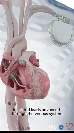 ⚡️ Pacemakers 101