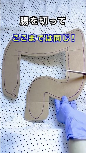 マイルズとハルトマンの違いは？#手術 #手術室看護師 #外科 #消化器外科