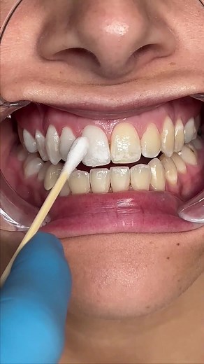 Teeth Whitening Strips: Cutting Effectiveness Revealed!