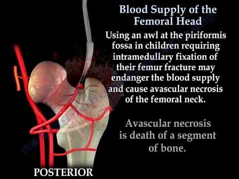 Avascular Necrosis, Blood Supply Femoral Head- Everything You Need To Know - Dr. Nabil Ebraheim