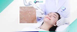 Melasma Treatment Program: Laser Options for Skin Clarity