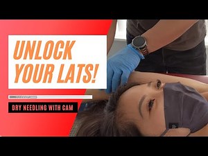 Unlocking the lat muscles (latissimus dorsi) with dry needles - large twitch response!