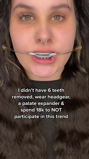 Only a few months of braces left🤩 #teethcheck #orthodontist #bracestok #headgear #overbite #palateexpander