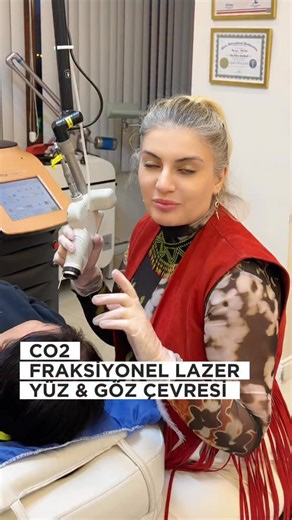 Dr. Meral Mutlu on Instagram: "💎 Lumenis UltraPulse CO₂ ile Yüz ve Göz Çevresi Gençleştirme UltraPulse CO₂ lazer, cildin en derin tabakalarına kadar inebilen fraksiyonel bir lazer teknolojisidir. Yüksek enerjiyi kontrollü şekilde cilt dokusuna ileterek, hem yüz hem de göz çevresinde kapsamlı bir yenilenme sağlar. Ameliyatsız bir yöntem olmasına rağmen cerrahiye yakın sonuçlar elde edilmesini mümkün kılar. 👁️ Göz Çevresi Uygulamaları • Göz kapaklarındaki düşüklüğü azaltır, cildi sıkılaştırarak 