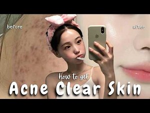 How To Get Acne Clear Skin FAST