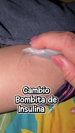 Vamos otra vez a cambiar la Bombita de Insulina, como cada 3 días 🥲 #Emmanuel❤️ #diabetestipo1 #type1diabetes #paratii #fyp