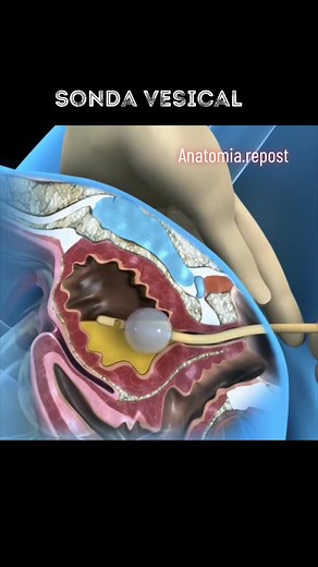Sonda Vesical: Tipos e Procedimentos Importantes