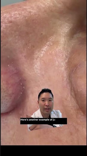 How does a skin cancer appear on the face?