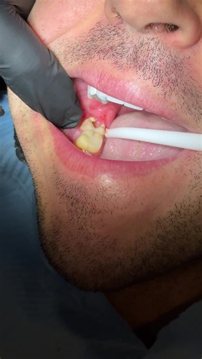 Lower Wisdom Tooth Extraction Techniques Unveiled