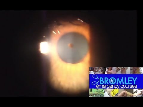 New To ED : Corneal Foreign Body Removal