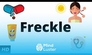 Mind Luster - Learn Freckle Causes Signs and Symptoms Diagnosis and Treatment