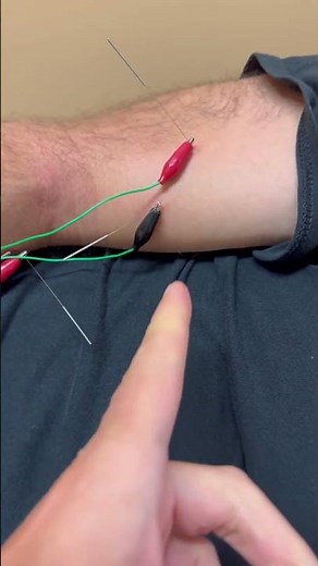 Treating a bicep tendon tear
