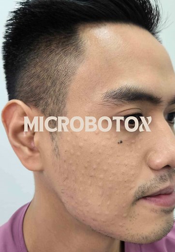 Microbotox Benefits for Smooth, Natural-Looking Skin