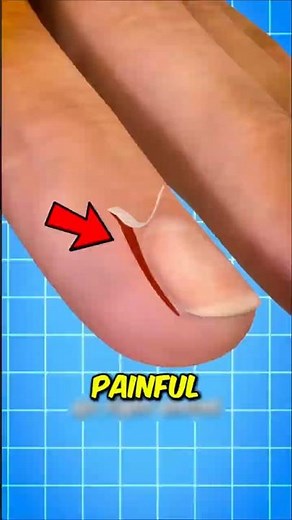 Got a Hangnail? STOP — Don't Make This Worse (Causes & Quick Fix)