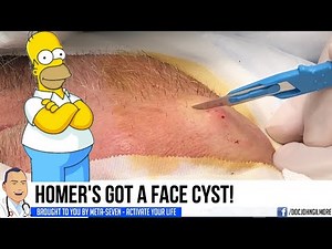 Homer's Double Cyst! SPLAT
