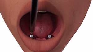 Be one of the first to check out our new technique animation for the OD Secure abutment system! The OD Secure abutment uses the industry’s lowest profile connection to attach dentures and partial dentures to dental implants. Visit http://biohorizons.com/odsecure.aspx to learn more. Questions? Call 888.246.8338 and speak to one of our Customer Care representatives today. | BioHorizons