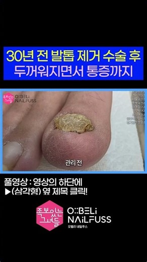 30년 전 발톱 제거 수술 후 두꺼워지면서 통증까지 😫 #내성발톱 #toenails #ingrown_toenail #발톱무좀 #무좀 #무좀발톱 #족보있는그녀들