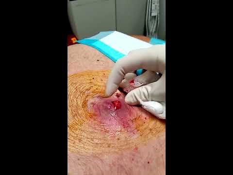 HD Graphic Step by Step Abscess and Infected Lipoma Drainage (Medical Education & Training)