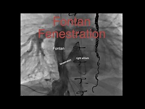 Fontan fenestration