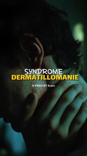 Sport Psychology & TCC , HYPNOSIS on Instagram: "La dermatillomanie est un trouble caractérisé par le besoin compulsif et répété de triturer, gratter ou pincer sa peau, entraînant des lésions (plaies, croûtes, cicatrices) et causant une détresse significative, souvent liée à l’anxiété ou au stress, et classée parmi les comportements répétitifs centrés sur le corps (CRCC). Ce comportement procure un soulagement temporaire, mais peut avoir des impacts importants sur la vie sociale et professionnel