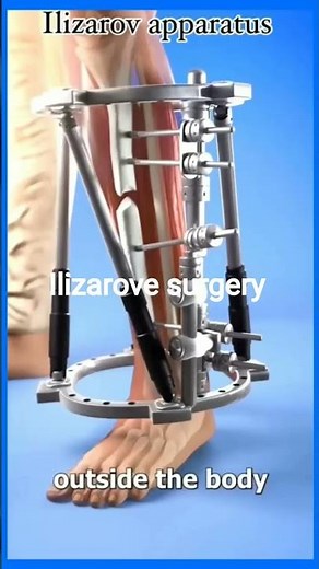 External Fixation Procedure for Femur and Tibia Fractures #ExternalFixation #FemurFracture