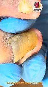 121K views · 657 reactions | Lasting Results: Discolored Nail Support with Gentle Care #FootSupport #FootCareTips #FootWellnessUSA | Tots Mags Wheel | Facebook