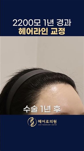 매끄러운 헤어라인을 위한 이식ㅣ헤어로의원 부산점ㅣ