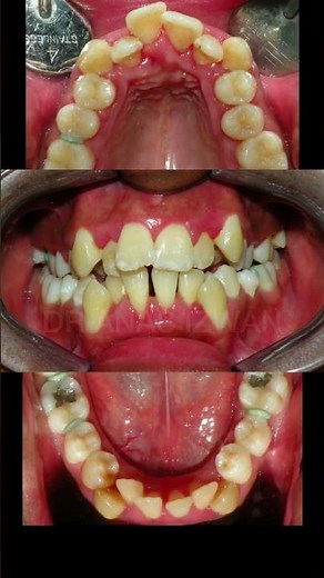 Braces for severe crowding teeth.