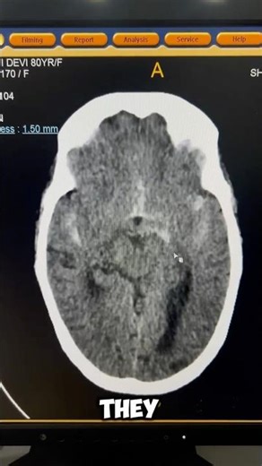 Subarachnoid Hemorrhage: The CT Scan You NEED to Know