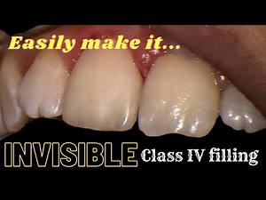 Invisible Class IV Composite Restoration | Step-by-Step Procedure • Video • MEDtube.net