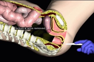 Abdominoperineal Resection Video - Trial Image Inc.