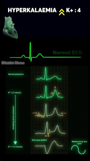 Abdallah Othman on Instagram: "🚨 Hyperkalemia : ECG Essentials 🚨 ✔️ HyperK: Peaked T → Sine wave → Cardiac arrest. Watch how increasing potassium levels affect the heart. As K+ rises, notice these ECG changes: Flattened P Wave: Impaired atrial depolarization. Widened QRS Complex: Delayed ventricular depolarization. These changes can lead to severe arrhythmias and potentially cardiac arrest if not treated promptly. #Hyperkalemia #Cardiology #ECG #MedicalEducation #CardiacArrest #Healthcare👇🏻