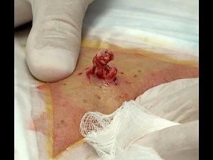 Abscessed Cyst @ Cobra's Mid-Back!