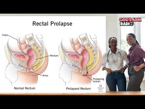 Understanding Rectal Prolapse, Signs and Symptom and Treatment / Management