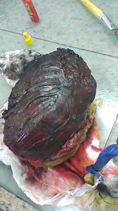 54K views · 845 reactions | This is a leiomyosarcoma, a smooth muscle...