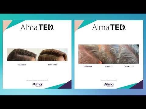 Hair Restoration using TED by Alma