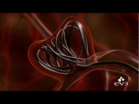Aneurysm Coiling Animation from ev3
