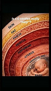 #skin#csection#lscs#operation#newborn#baby#ot#ytshorts#midwifery#surgery#obstretics#nursing #gynaec