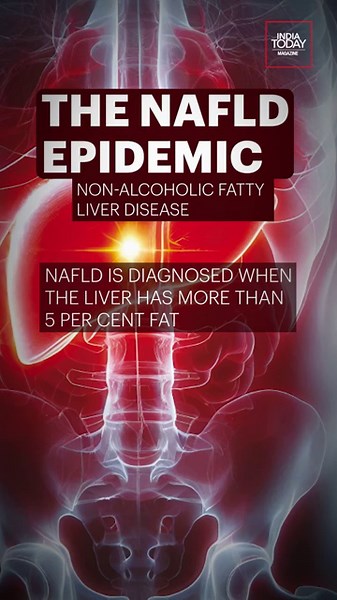 Deadly Non-alcoholic Fatty Liver Disease - Symptoms Safeguards