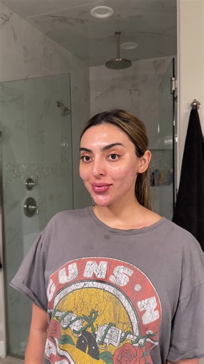 Navigating Acne: My Skin Clarity Journey