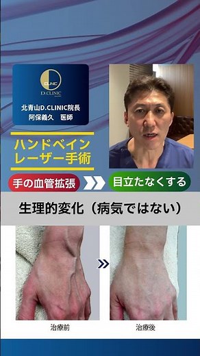 Information from the medical field: [Hand Veins] 2. Is hand vein treatment necessary? #handveins ...