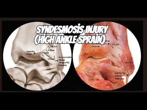 How to diagnose and treat a Syndesmosis Injury (High Ankle Sprain)