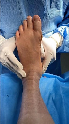 Corrective surgery for hallux valgus! Do you know how it works?!
