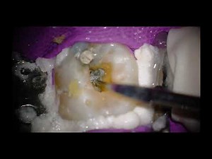 Eighteeth Ultrasonic Scaler Ultramint Pro Function Introduction Compatible with 99% Scaler Tips