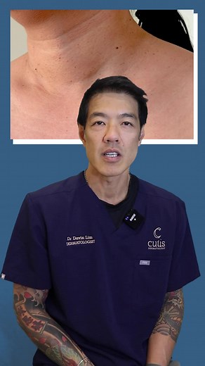 Treating skin tags with Dr Davin Lim #skintags #skintagremoval #skincare #popping #skincaretips