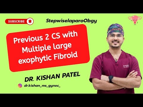 TLH in case of Previous 2 C-Sections | Multiple Large Exophytic Isthmic Fibroids by Dr. Kishan Patel