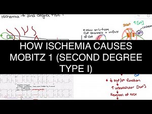 How Ischemia Causes Mobitz Type I (Second-Degree AV Block) | ECG Analysis & Pathophysiology