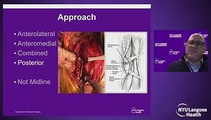 Tibial Plateau Fractures: Tips and Tricks