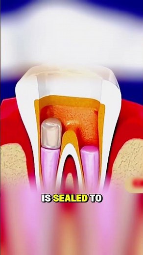 Root Canal Treatment (3D Animation)#3danimation #medicaleducation #healthcare #fyp