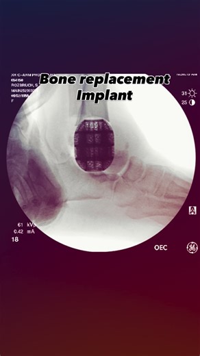 S Robert Rozbruch, MD on Instagram: "Nureen had a 6 cm ankle and distal tibial #bonedefect caused by a failed ankle replacement. I used a custom made porous bone replacement implant with an ankle nail for #limbsalvage . Recovery has been great and fast. #footandanklesurgery #Rozbruch #aaos #llrs #orthopedicsurgery #liveyourbestlife @all4ortho #orthopedicsurgeon #hospitalforspecialsurgery #limblengthening @hspecialsurgery @limbdeformity @reifmd #SRobertRozbruchMD www.limblengthening.com www.hss.e